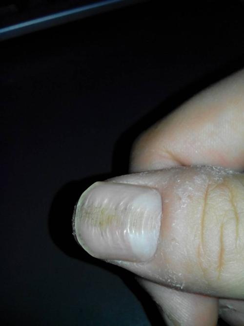 指甲问题:两个大拇指指甲有横纹 一道沟一道沟的,并且每道横纹中间低