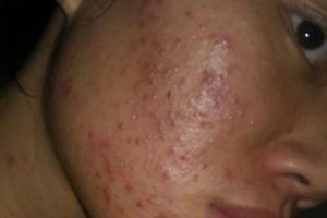 这一个多月来脸上和脖子老是长红色的痘痘,特别是脸大面积长